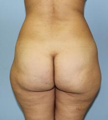 before Brazilian Butt Lift 29