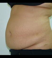 before Tummy Tuck 12