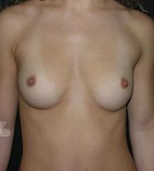 before Breast Augmentation 64