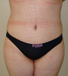 after Tummy Tuck 3