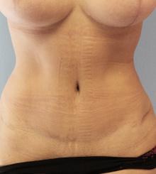 after Tummy Tuck 15