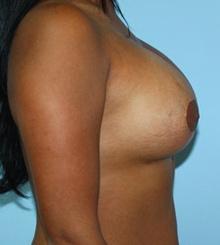 after Breast Lift 28