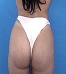 after Brazilian Butt Lift 27