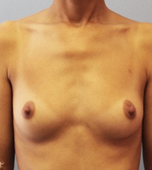 before Breast Augmentation 57