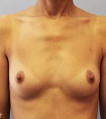 before Breast Augmentation 57