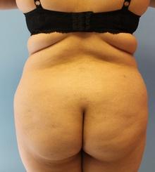 before Brazilian Butt Lift 4