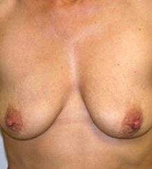 before Breast Lift 13