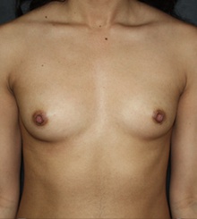 before Breast Augmentation 36