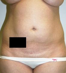 before Body Sculpting 2