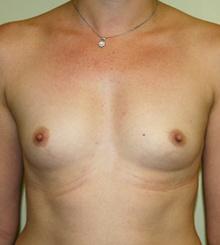before Breast Augmentation 13