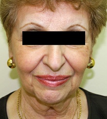 before Face Lift 1