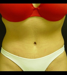 after Tummy Tuck 10