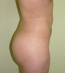 after Brazilian Butt Lift 11