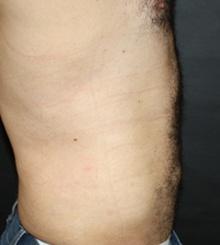 after Body Sculpting 5