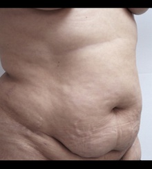 before Tummy Tuck 6