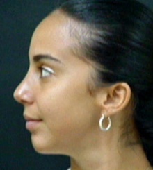 after Rhinoplasty 2