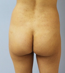 before Brazilian Butt Lift 18