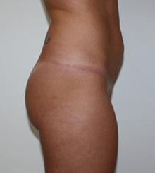 before Brazilian Butt Lift 7