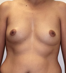 before Breast Augmentation 27