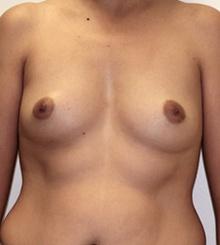 before Breast Augmentation 27