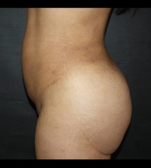 after Brazilian Butt Lift 12