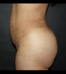after Brazilian Butt Lift 12