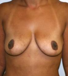 before Breast Lift 15