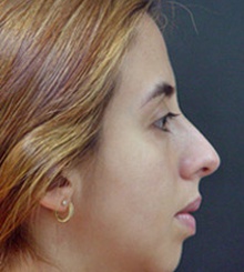 before Rhinoplasty 1