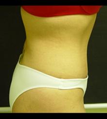 after Tummy Tuck 10