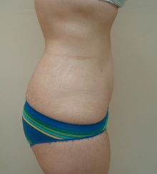 after Body Sculpting 10