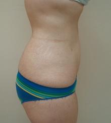 after Body Sculpting 10