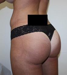after Brazilian Butt Lift 7