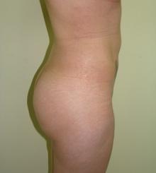 after Brazilian Butt Lift 11