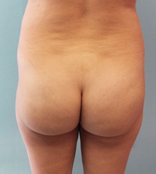 before Brazilian Butt Lift 25
