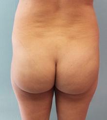 before Brazilian Butt Lift 25