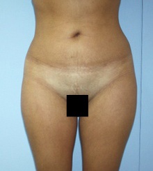 before Body Sculpting 9