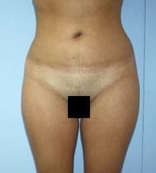 before Body Sculpting 9