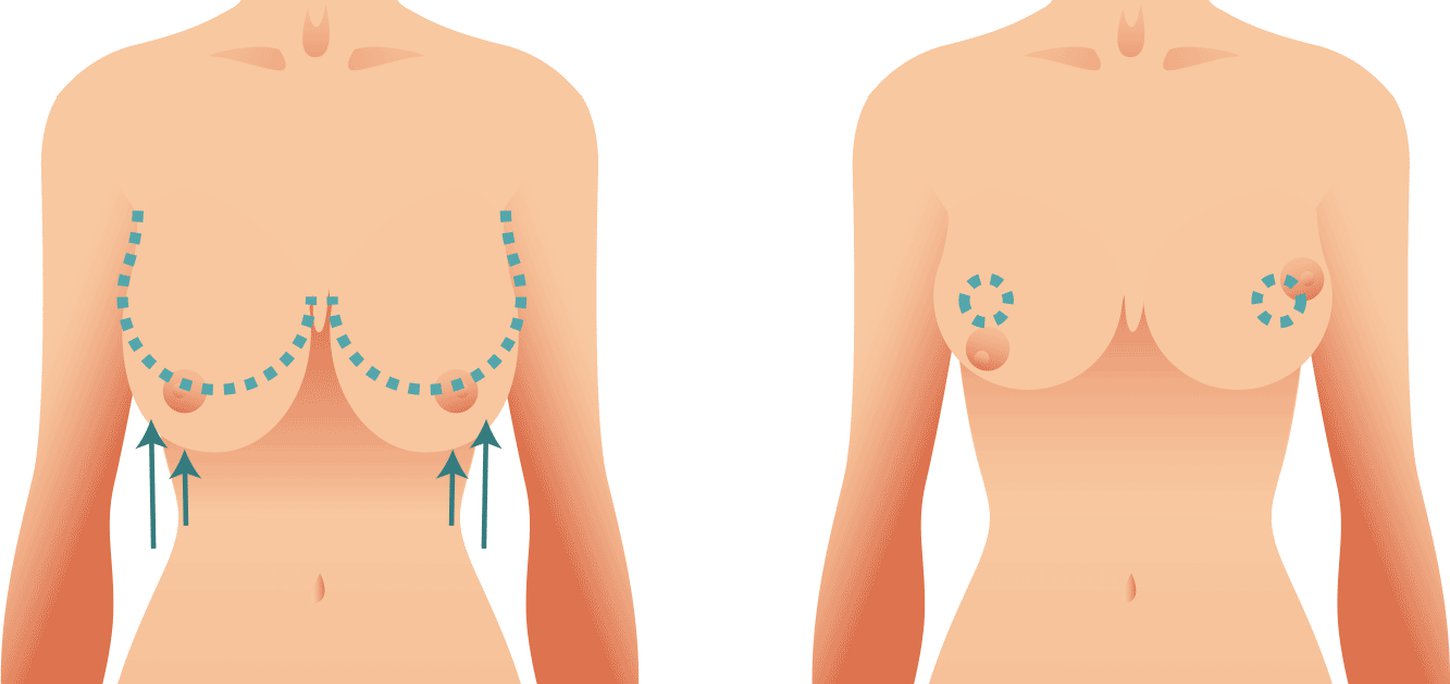 Breast Lift Surgery Areola and Reposition