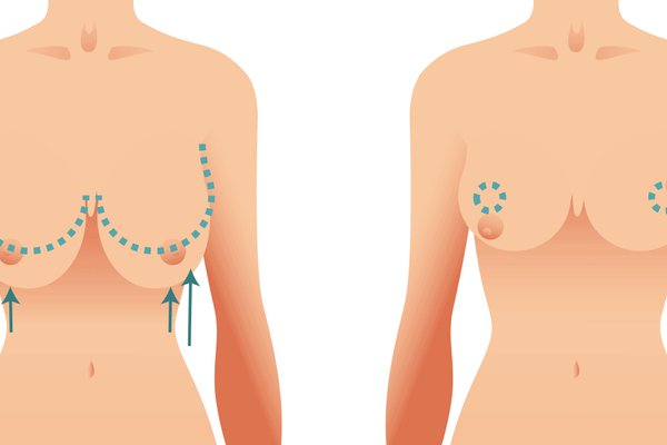 Lifting de mama Surgery Areola and Reposition