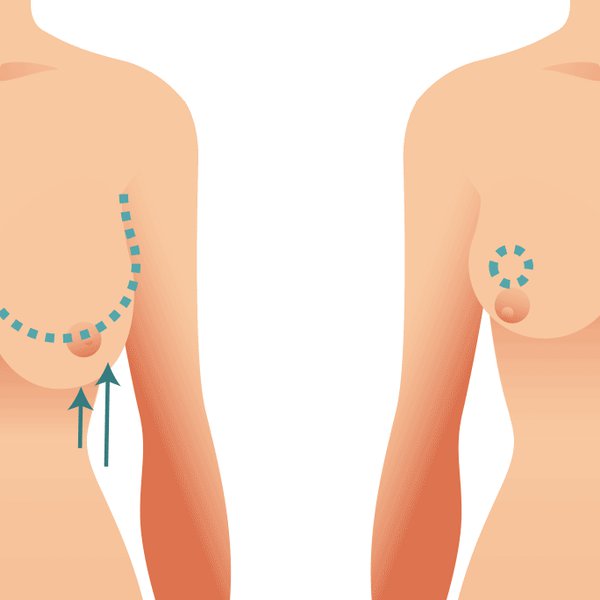 Breast Lift Surgery Areola and Reposition