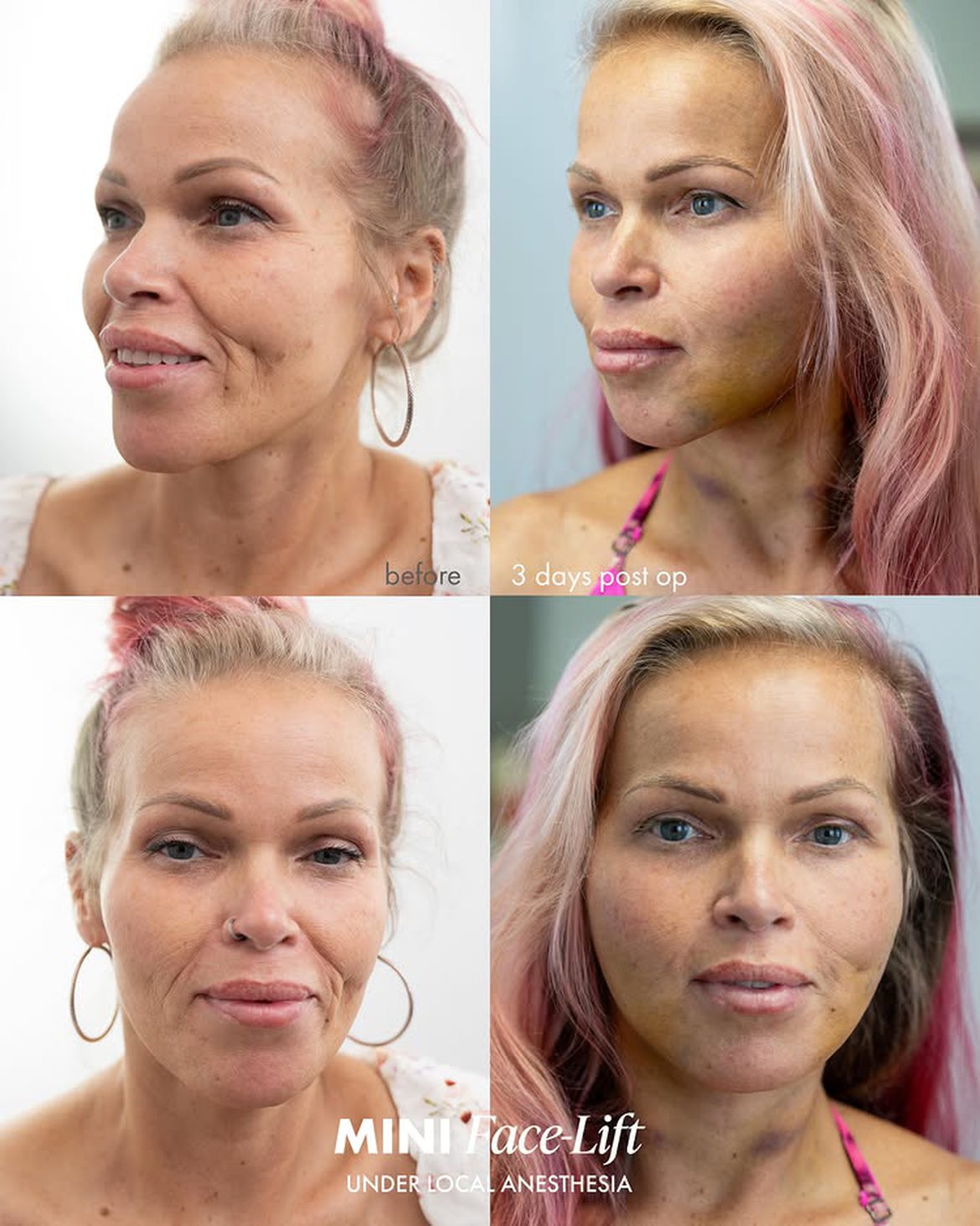 55 years old woman Mini Lift Results