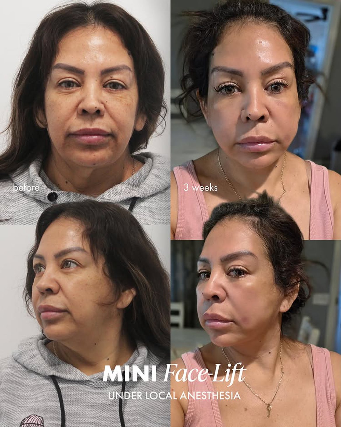 Mini Lift CG Cosmetic