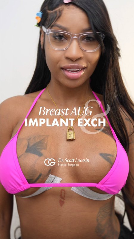Before & After Story: Breast Implant Exchange Results