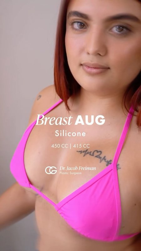 Brazilian Butt Lift (BBL) & Breast Augmentation Success