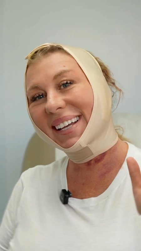 Mini-Face Lift and Chin Lipo under local anesthesia.