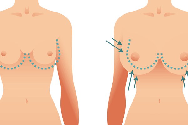 Lifting de mama Surgery Visually Explained