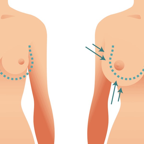 Breast Lift Surgery Visually Explained