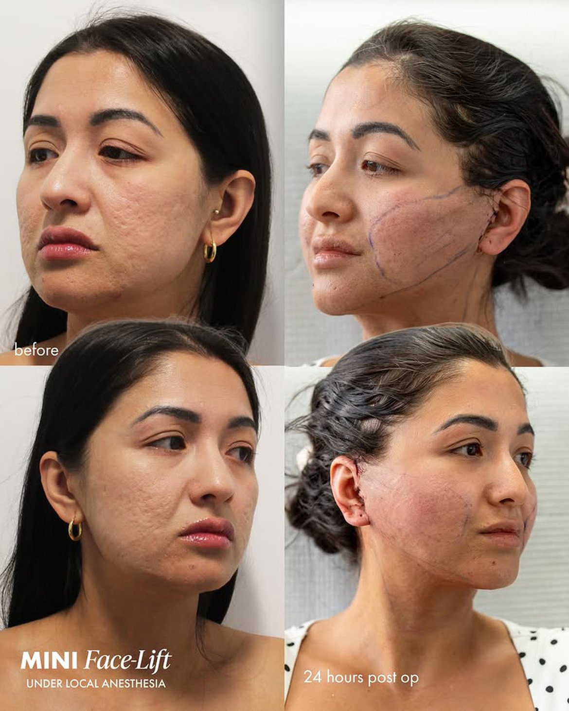 45 Years old woman Mini Lift results
