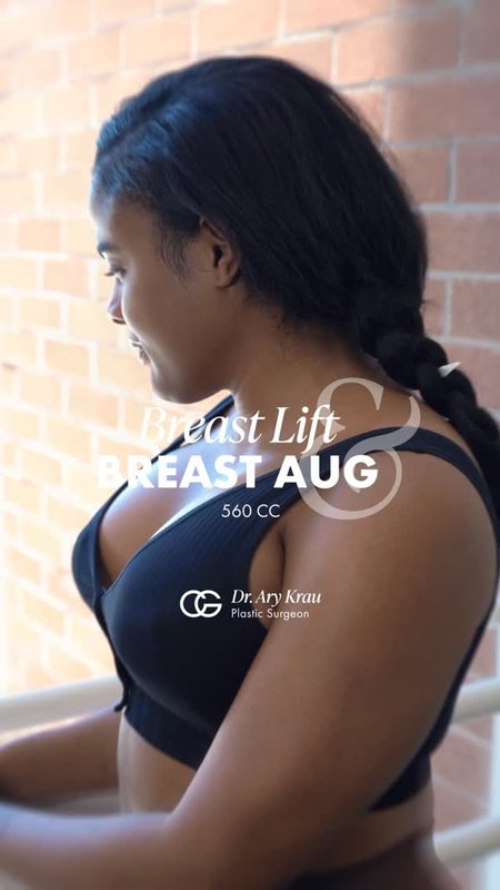 Breast Lift (Mastopexy) Testimonial from a Miami Patien