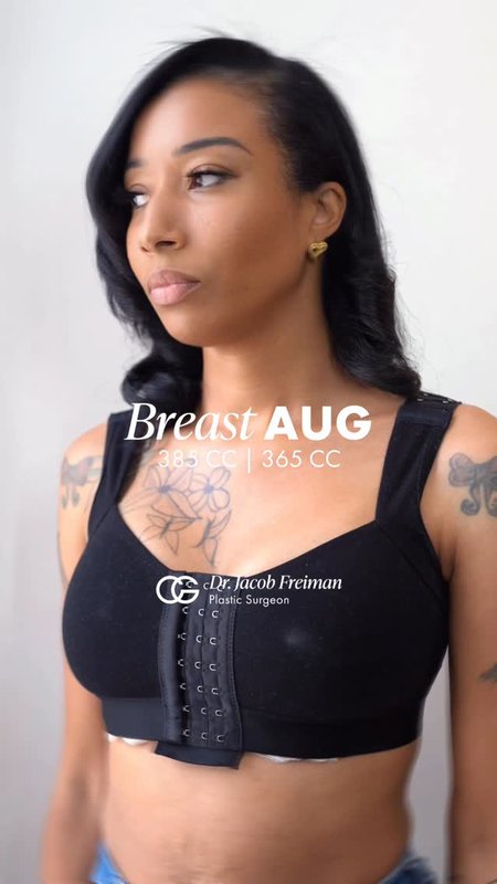 CG Cosmetic Patient Journey: Breast Augmentation